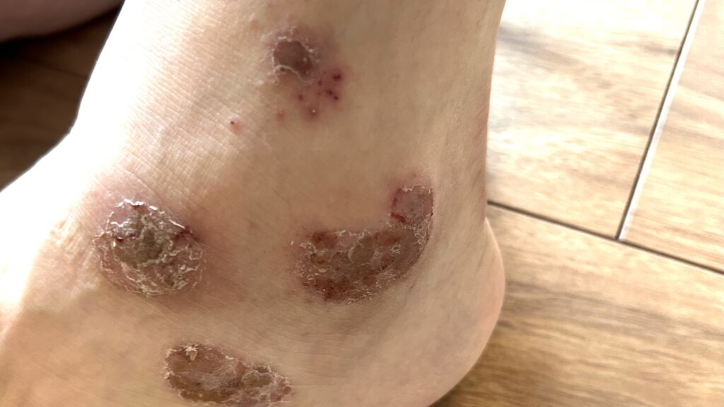 脱ステ後くるぶし