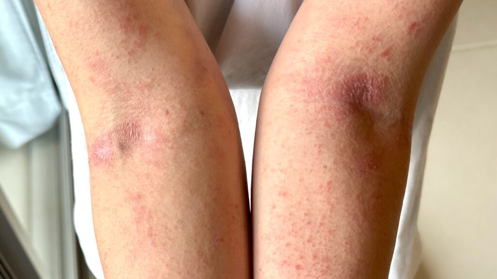 脱ステ後腕内側